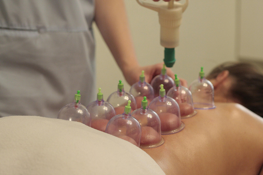 Cupping-massage Cupping Massage performed on a woman